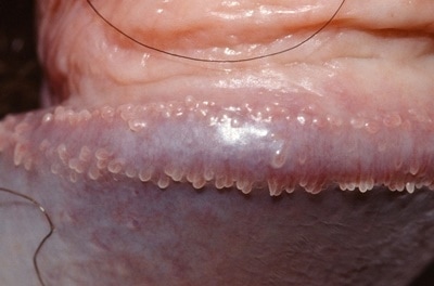 Is Pearly Penile Papules A Transmissible Disease